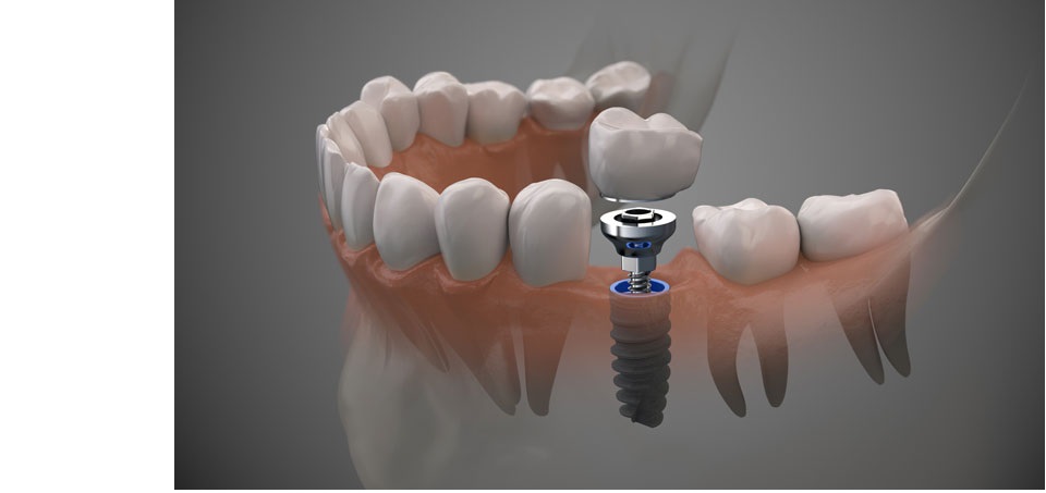 Dentist Supports